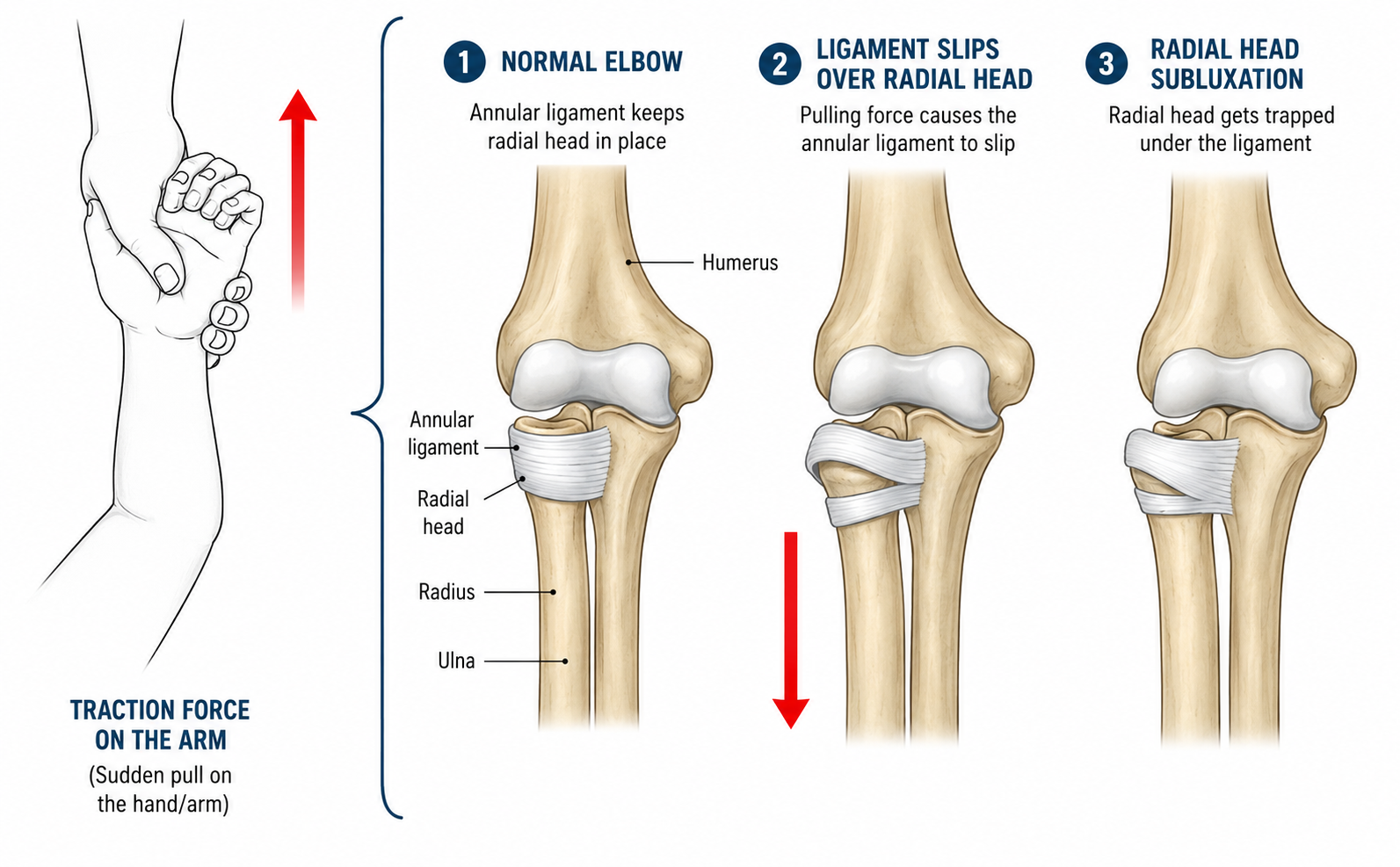 Pulled Elbow (Nursemaid's Elbow) in Children: Causes, Signs & What to Do | OLIR Super Speciality Hospital, Chennai
